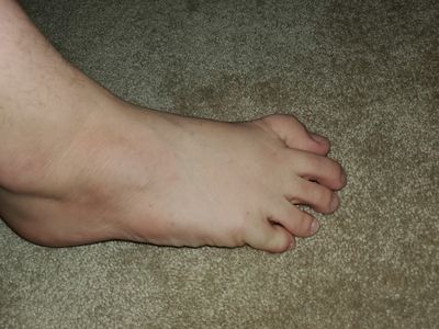 ictoesandfeet thumbnail