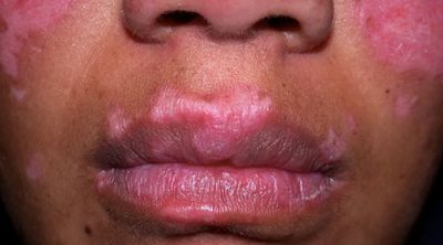 lupusbeauty86 profile